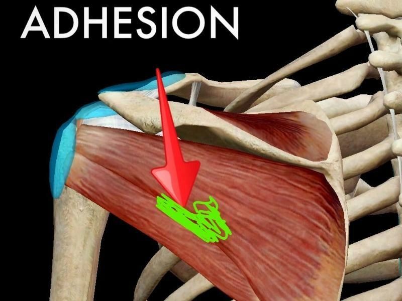 One of the most common causes of shoulder pain and dysfunction